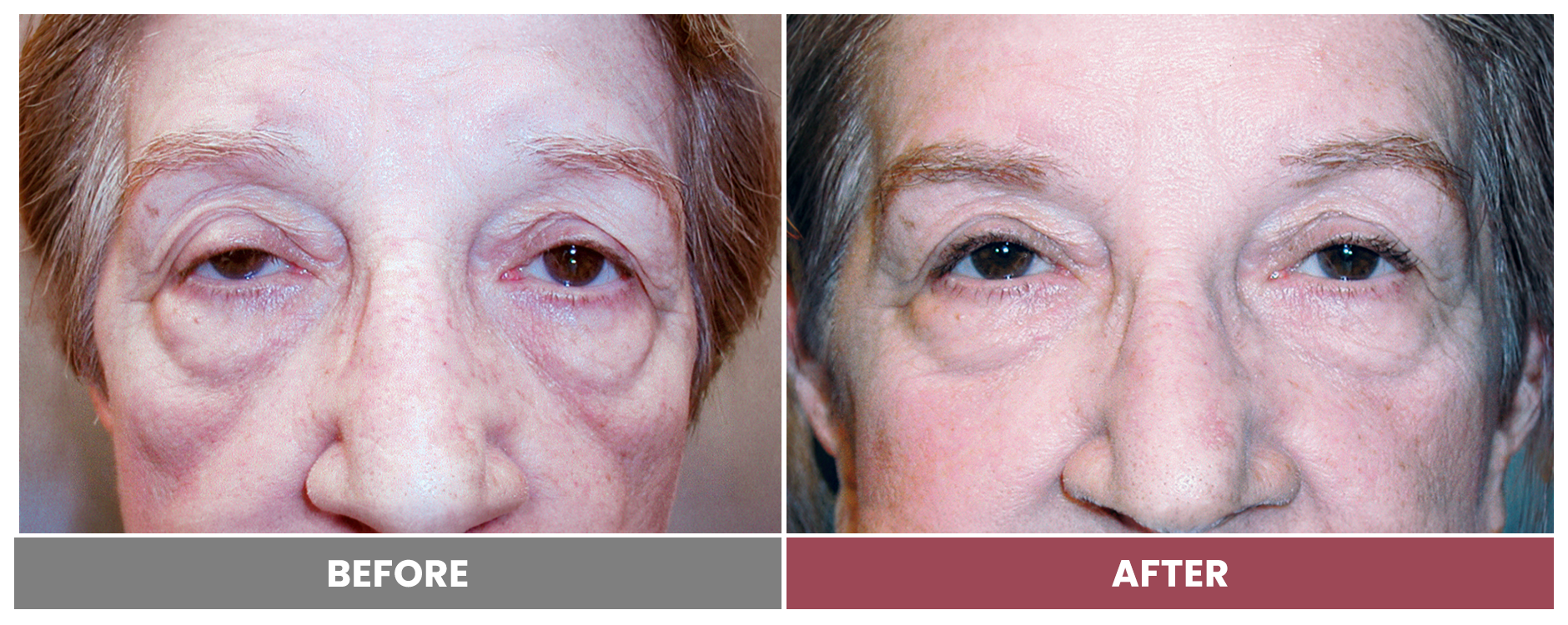 PTOSIS REPAIR - Case 4